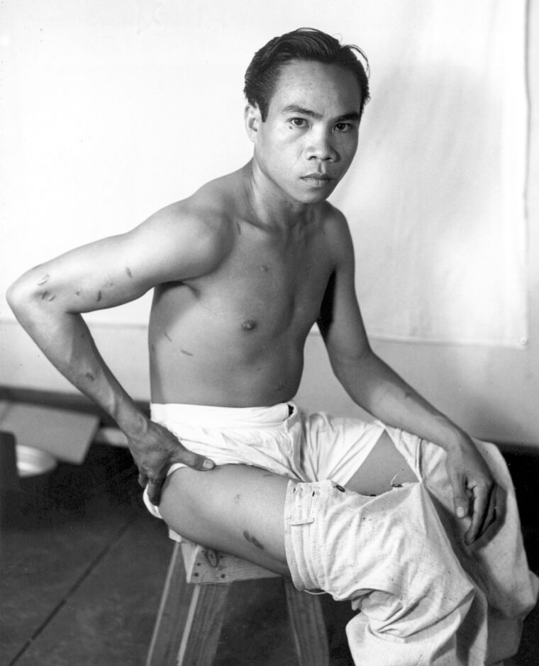 Teofilo Candari, a Filipino cook at a college in Manila, shows 33 bayonet wounds inflicted by Japanese Marines.