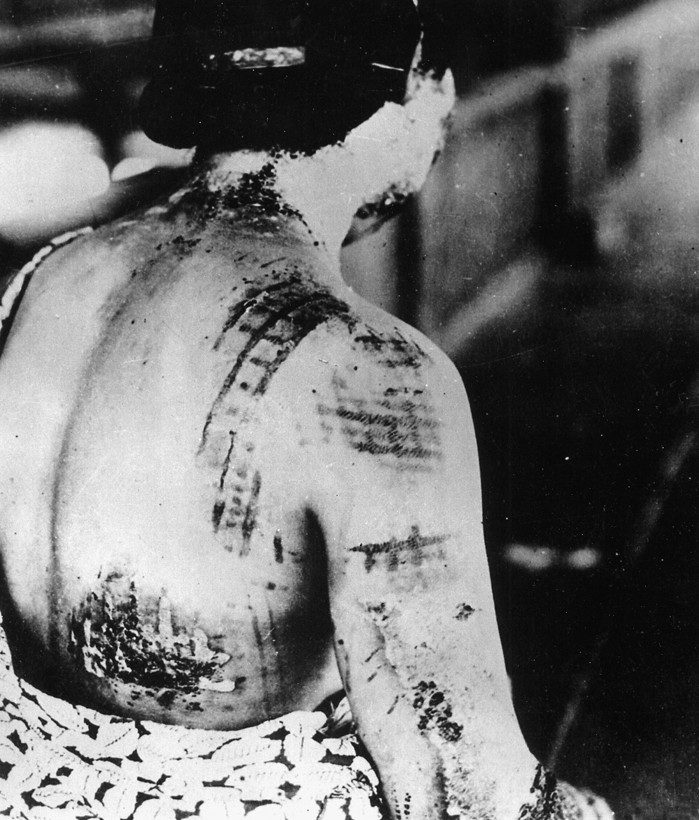 Exposure to thermal rays caused the pattern of a woman’s cloth kimono to be seared into her skin following the explosion of an atomic bomb that killed thousands.